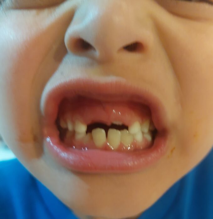 あとちょっとで歯が抜けそう！から一瞬で抜けたまさかな方法とは？