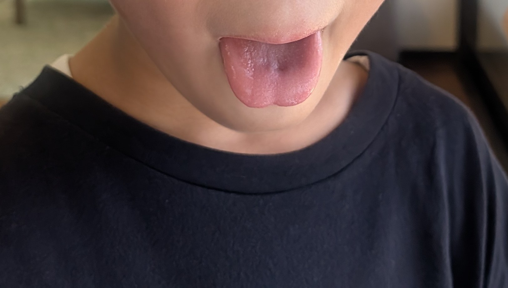 舌ったらずの6歳長男が受けた舌小帯切開手術。してよかった？約7年後の今